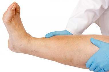 Causes and Treatments of Varicose Veins