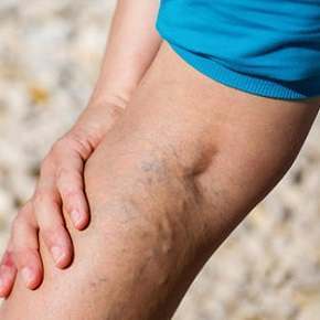 Varicose Veins – Causes, Prevention and Treatment